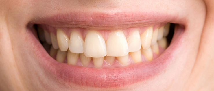 8 Habits That Can Stain Your Teeth